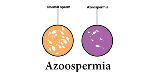 Azoospermia
