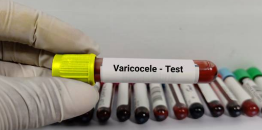 Varicocele
