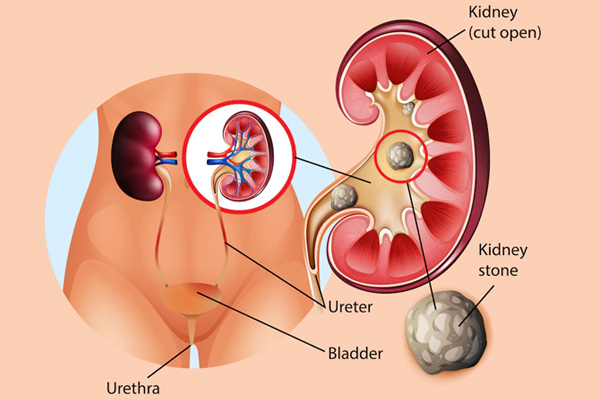 Cross-section of the kidney and urinary tract with a kidney stone in the ureter; inset shows the kidney's internal structure.