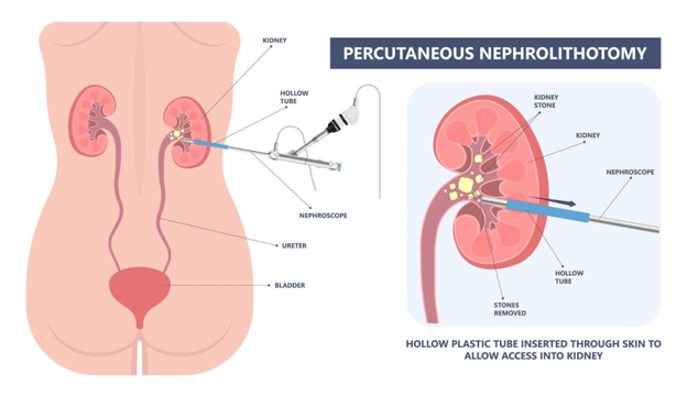 Diagram of percutaneous nephrolithotomy showing a hollow tube and nephroscope inserted through the skin to access the kidney and remove stones.