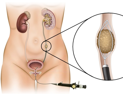Medical illustration of female urinary and reproductive organs with a catheter delivering treatment; magnified inset shows beads/embolics in a reservoir near the target vessel.