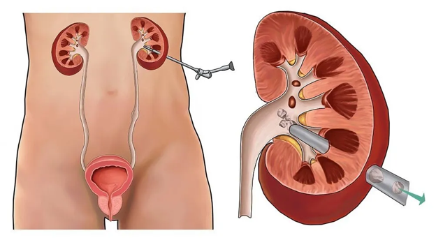 Medical illustration of the urinary system: kidneys, ureters, and bladder, with catheters/nephrostomy tubes entering a kidney from the side.
