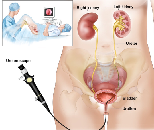 Diagram of the urinary system showing kidneys, ureters, bladder, and urethra with a ureteroscope entering the bladder. (informative)